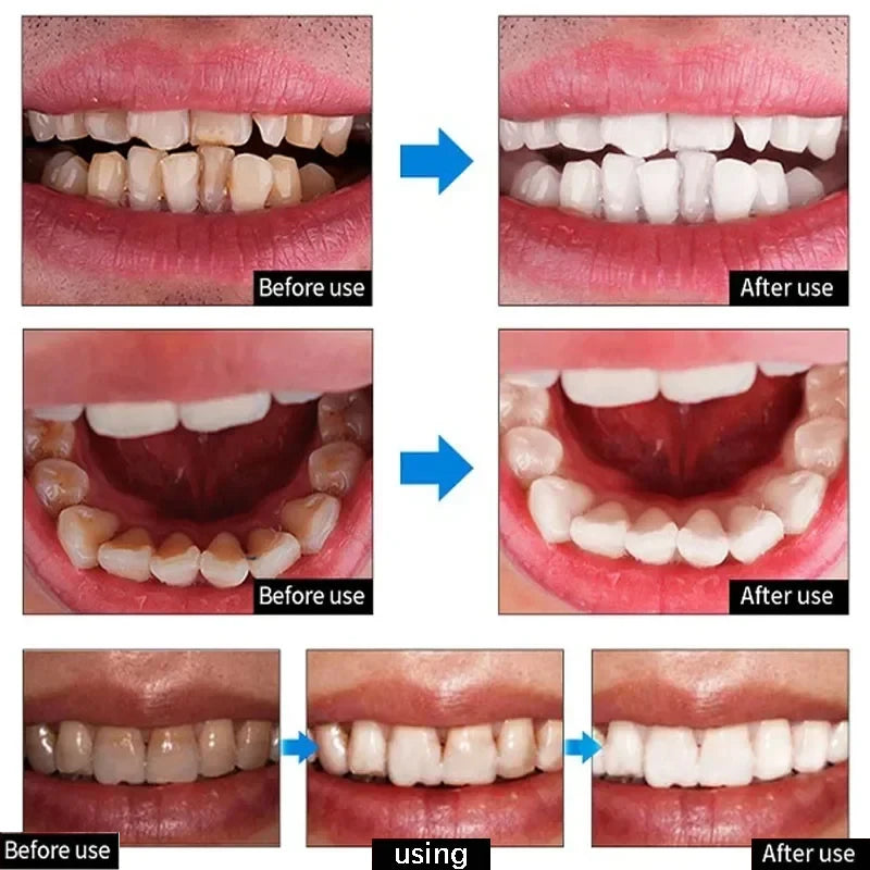 Teeth Whitening Toothpaste Remove