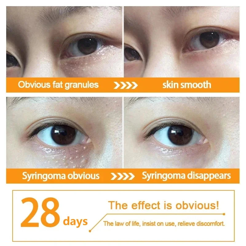 Fat Granules Remover Eye Cream