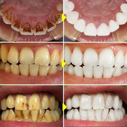 Teeth Whitening Toothpaste Remove